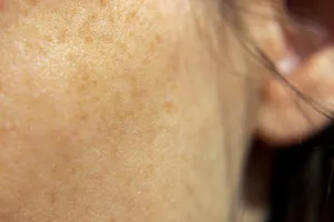 기미-없애주는-방법