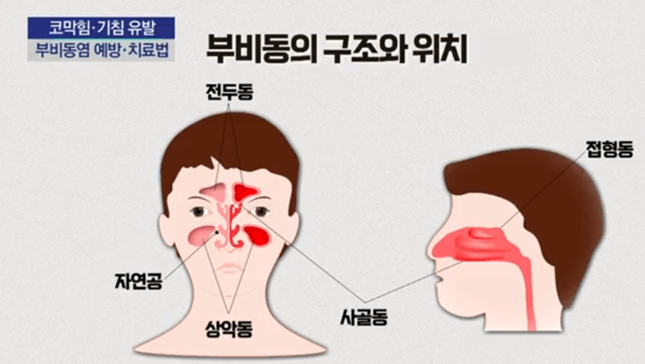 부비동염-원인-증상-치료-예방-방치하면-합병증으로