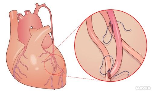 ldl 콜레스테롤 낮추는 방법
