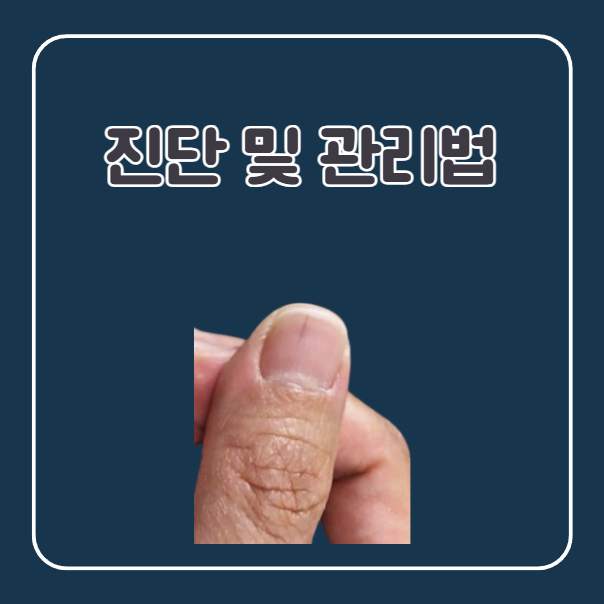 손톱 밑 검은줄 진단 및 관리법
