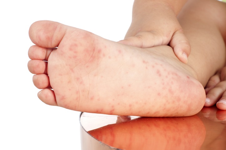 수족구병-발증상