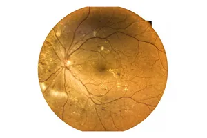 망막-박리-증상