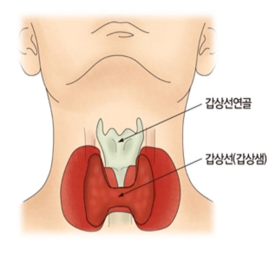 갑상선 기능 저하증
