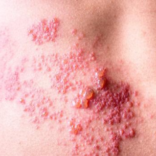 대상포진 피부 물집