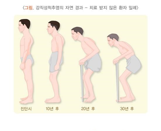 강직성 척추염 지연결과