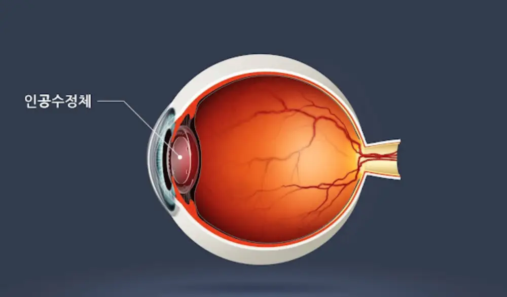 인공수정체