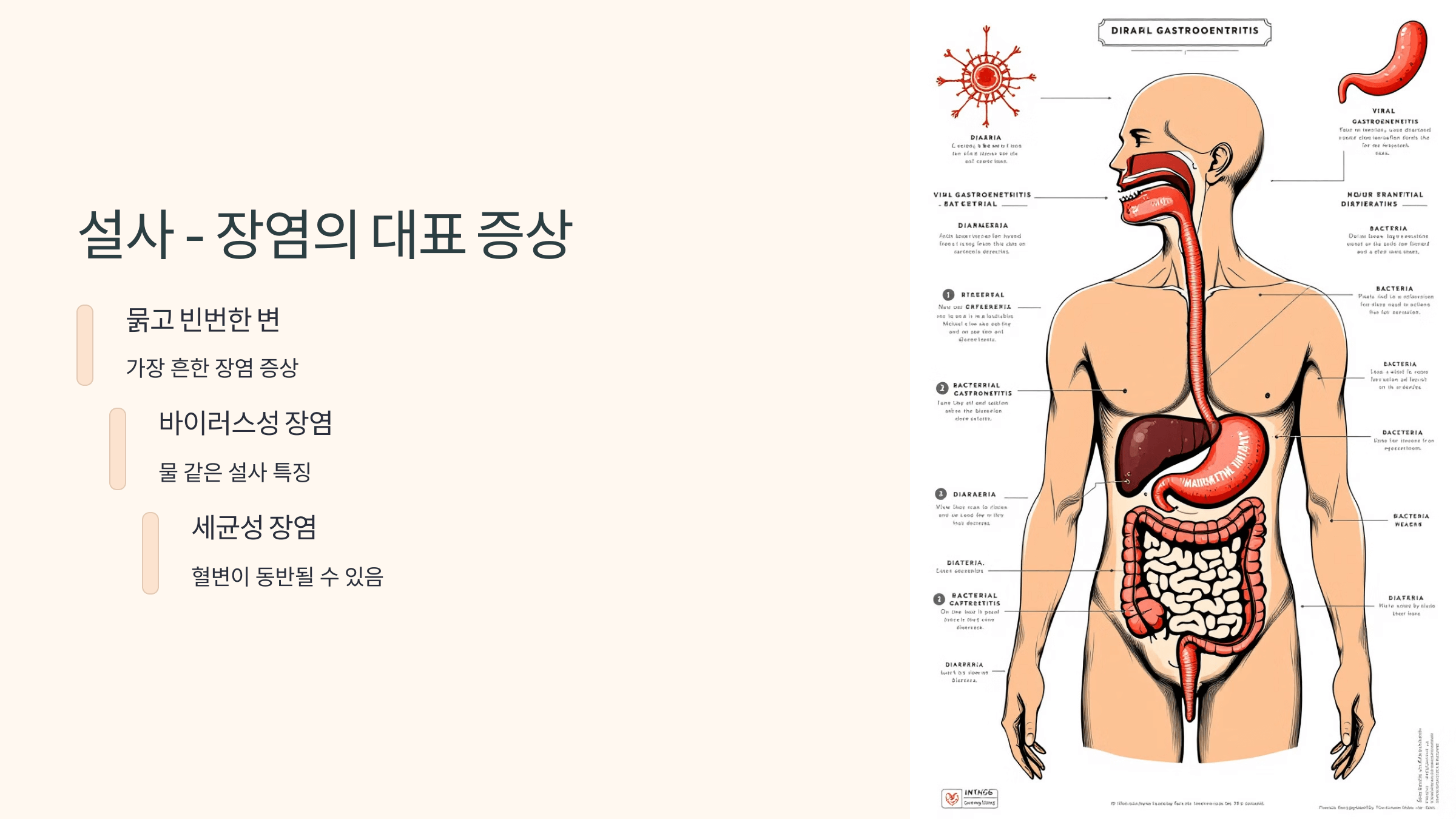 장염과 관련된 사진입니다.