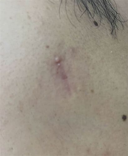 표피낭종 수술