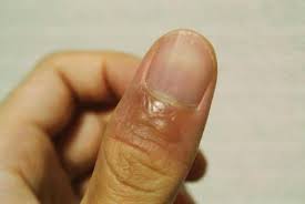 화상 물집 치료방법