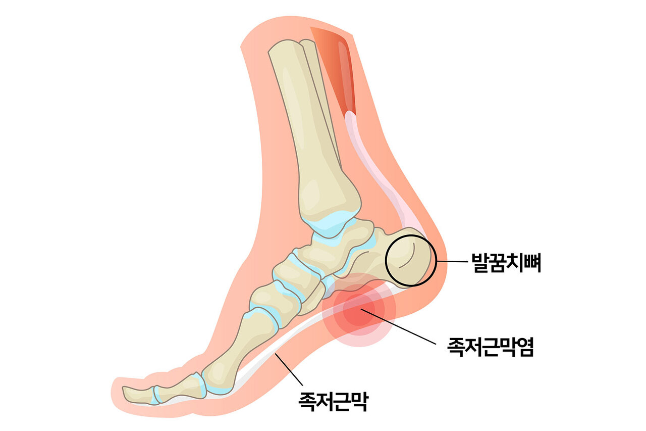 족저근막염-사진