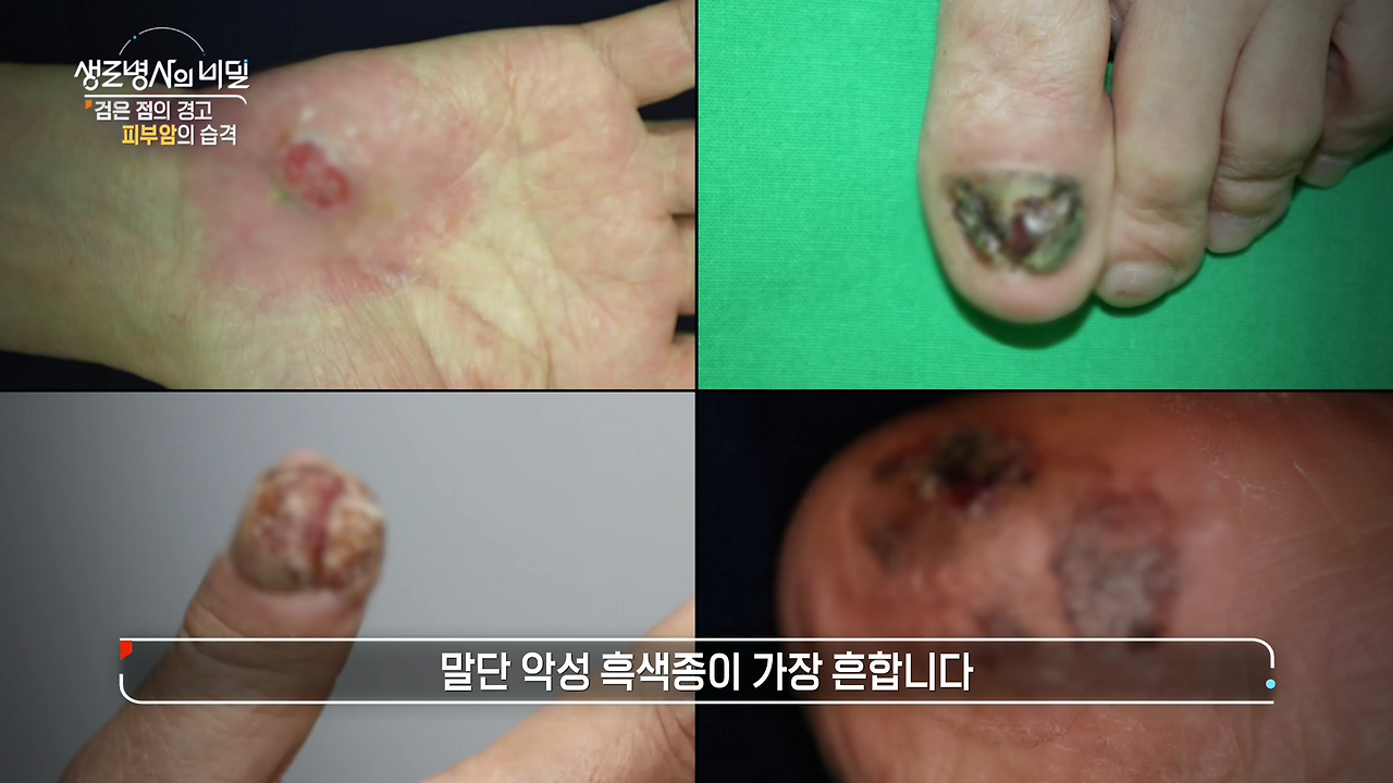 생로병사의 비밀 피부암 검은점