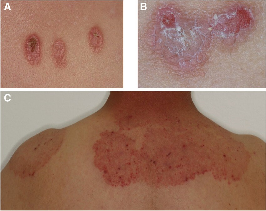 [L00-L99] ⅩⅡ. 피부 및 피하조직의 질환(L00-L99)