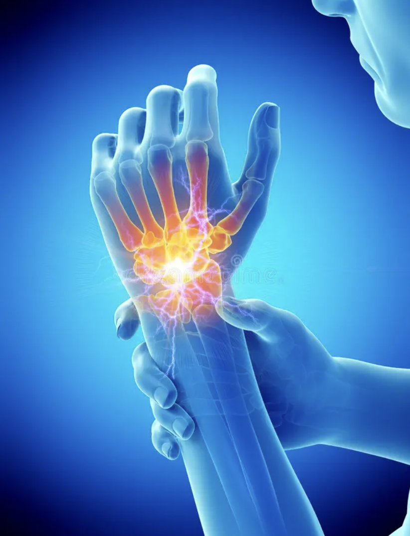 손목터널증후군 예방법 관련 이미지