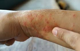 피부 발진 종류 10가지: 접촉 피부염, 두드러기, 장미색 비강진 등