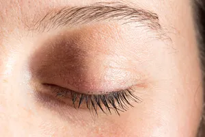 눈두덩이-지방제거-비용