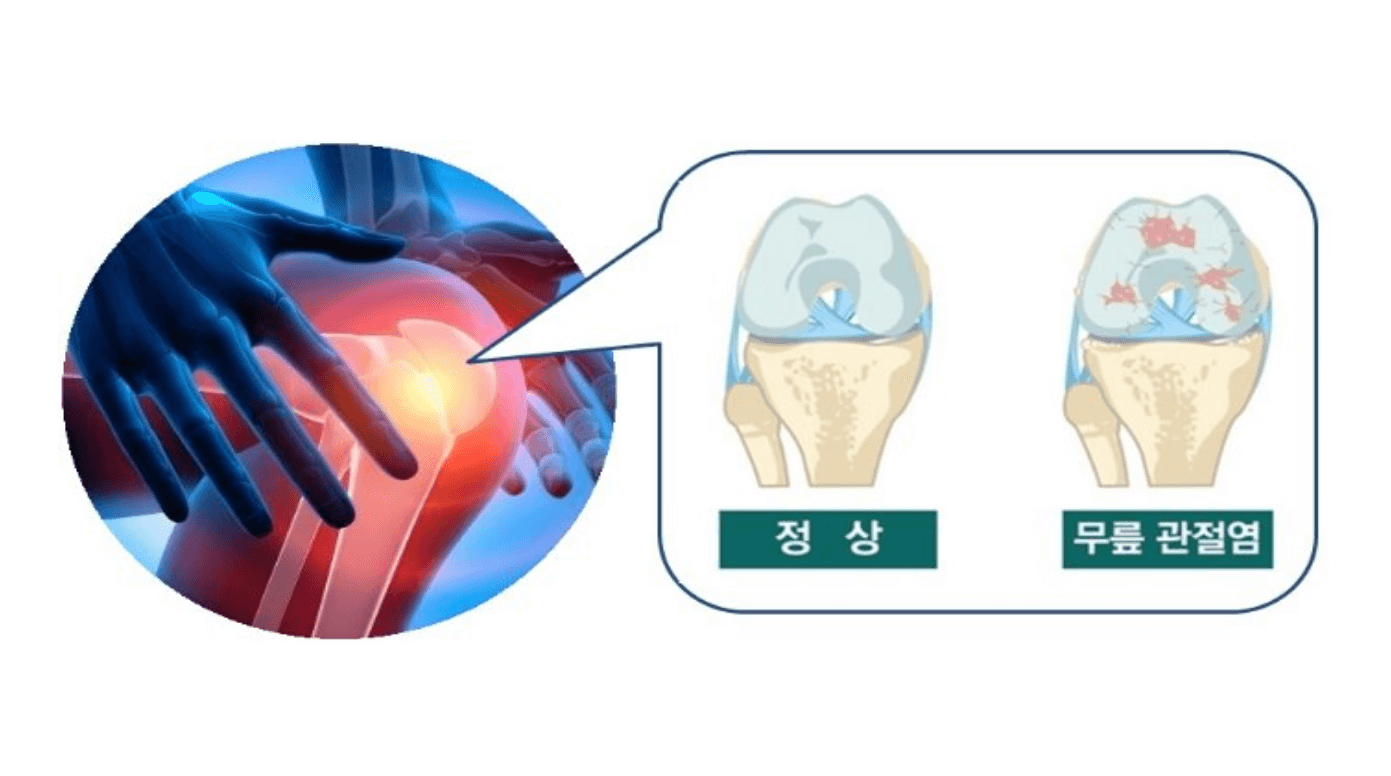 무릎-관절염-정상-연골-비교-사진