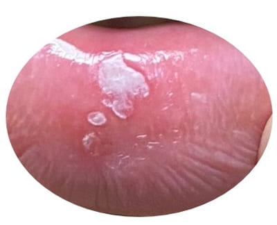 알보칠을-바른-직후