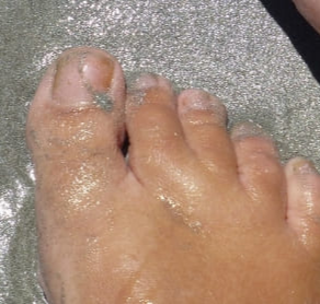 발톱 검은색 세로줄&amp;#44; 단순 멍일까? 흑색종일까?