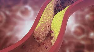 콜레스테롤 낮추는 방법 10가지