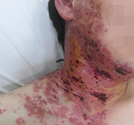 대상포진경추부위