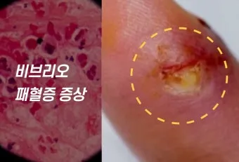 패혈증이란 무엇인지 원인 증상 치료 예방법_16