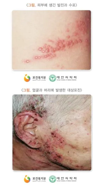 대상포진 감염 증상 부위 손 허리 허벅지_9