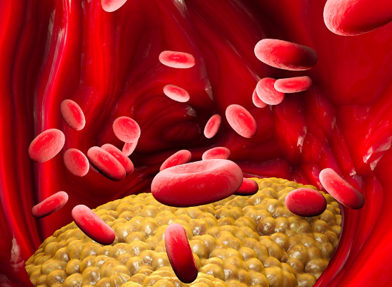 고지혈증 원인 증상 관리법 콜레스테롤관리 혈관건강 심혈관질환예방 건강검진 생활습관개선 운동효과 식이조절 중성지방 이상지질혈