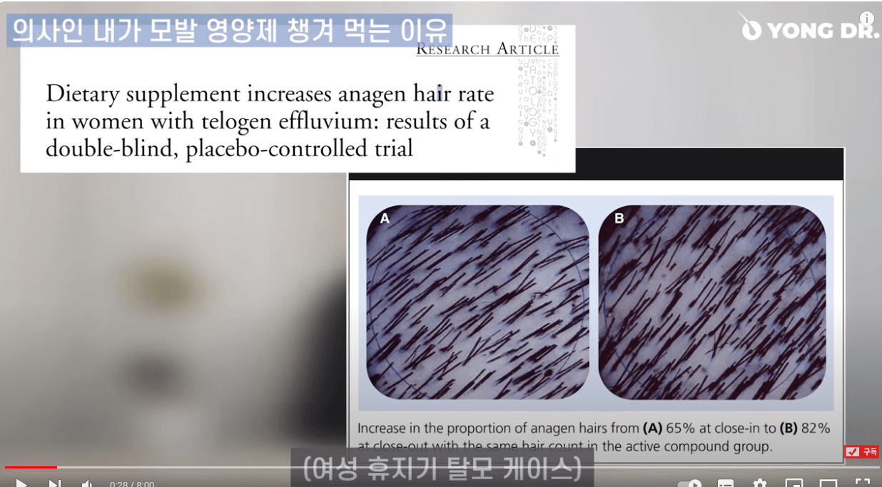 탈모에 