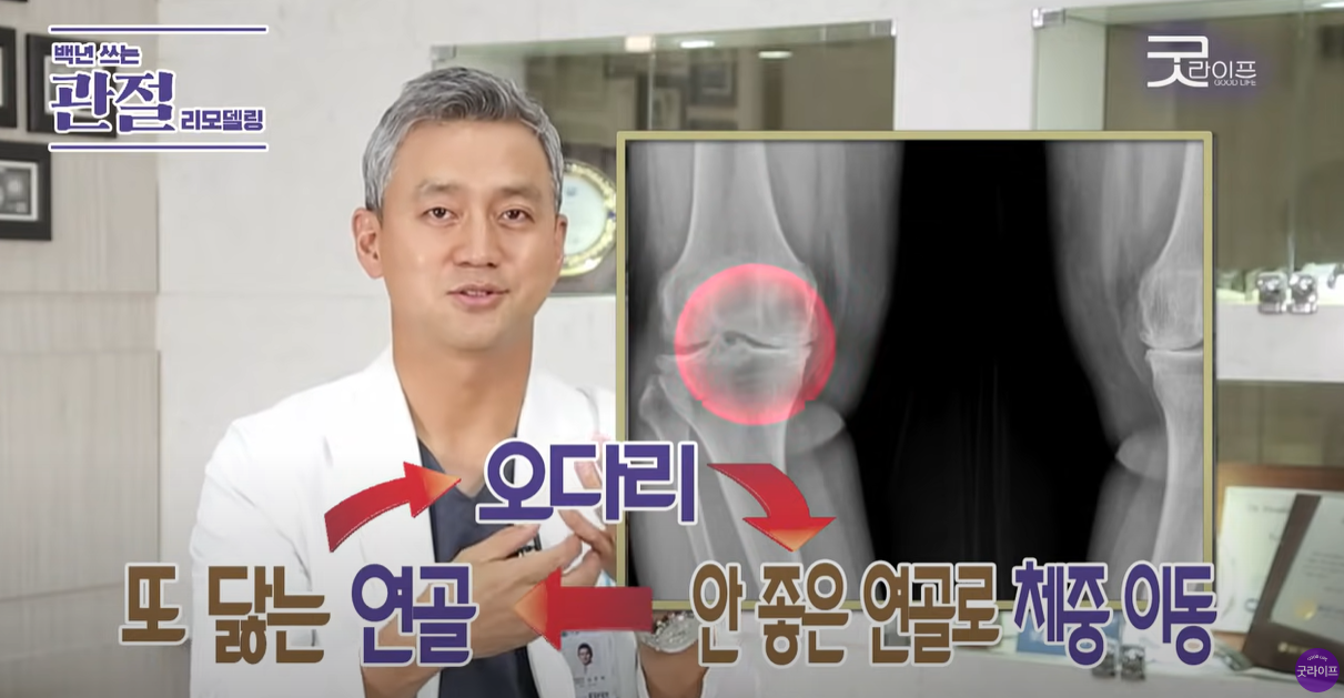 오다리는 연골을 계속 닳게 만듭니다.