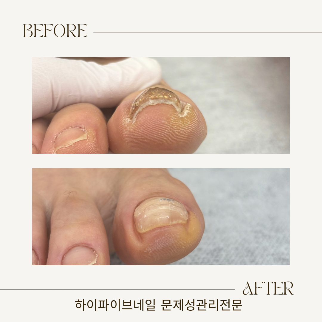 하이파이브네일샵 파고드는 손발톱 미용케어 비포애프터
