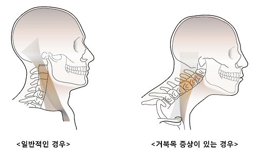 (뒷골이 땡기는이유)거북목 고쳐주자 메인이미지
