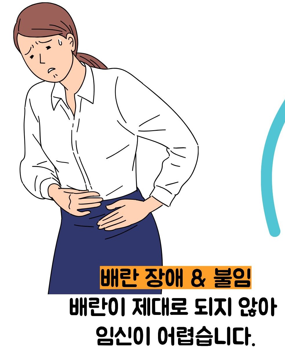 다낭성 난소 증후군 증상