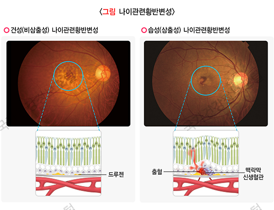 나이관련황반병성