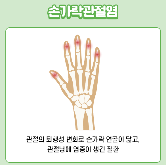 손가락관절염