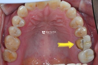 오른쪽-어금니-안쪽이-깨진모습을-구체적으로-설명해주는-치과