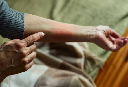 에스로반 연고 효능