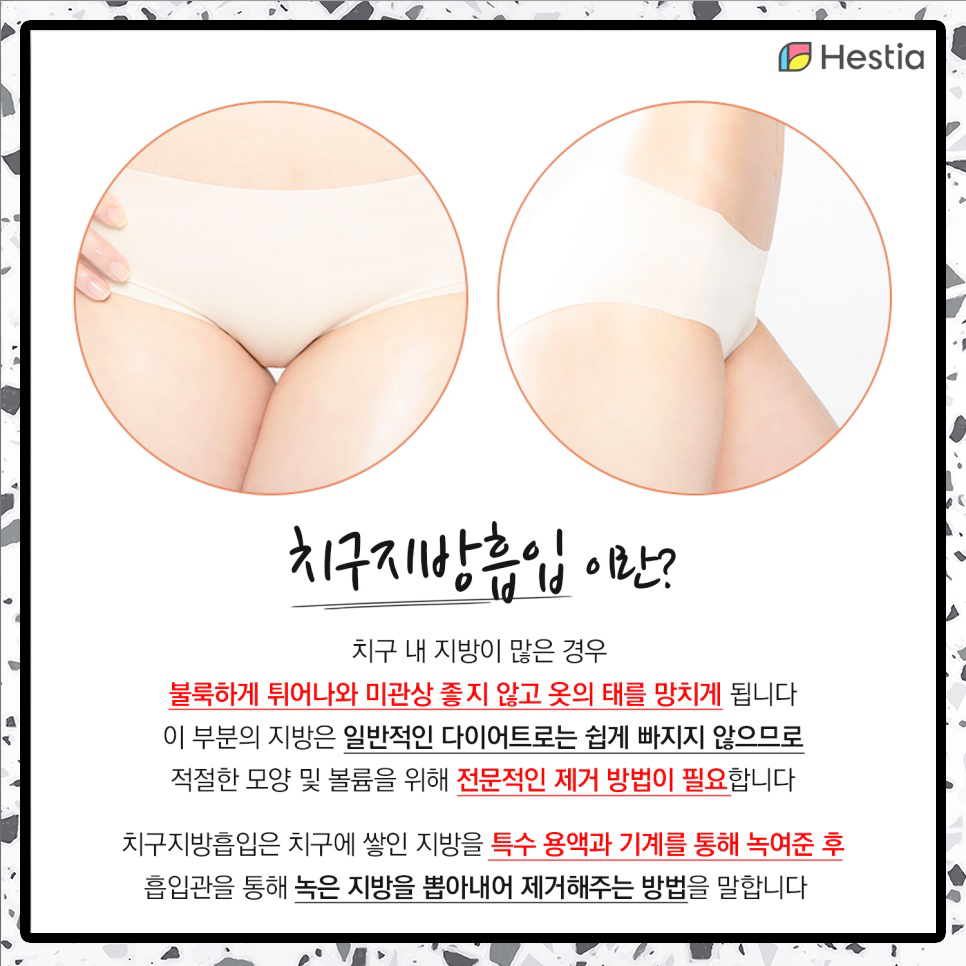 치구지방흡입이란?