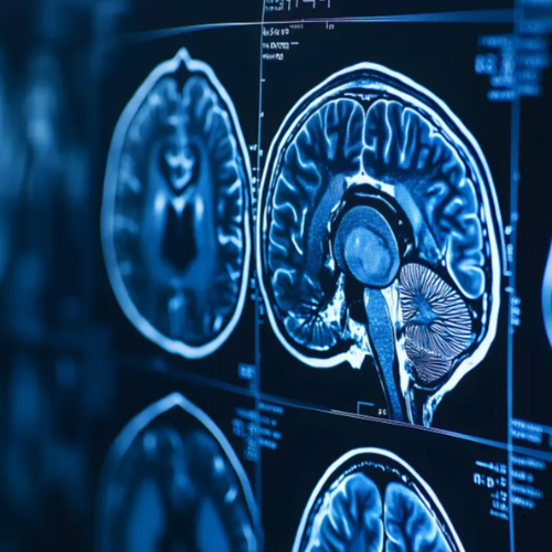 모야모야병 증상 MRI 판독