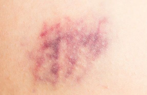 혈소판 수치가 낮으면