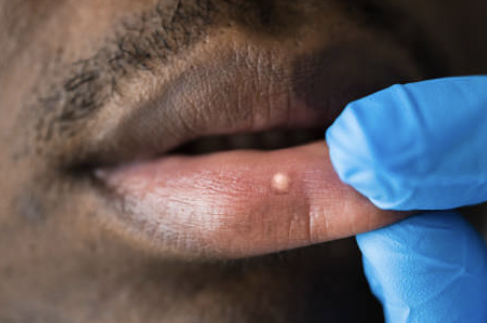 입술에 물집이 생기는 이유 24