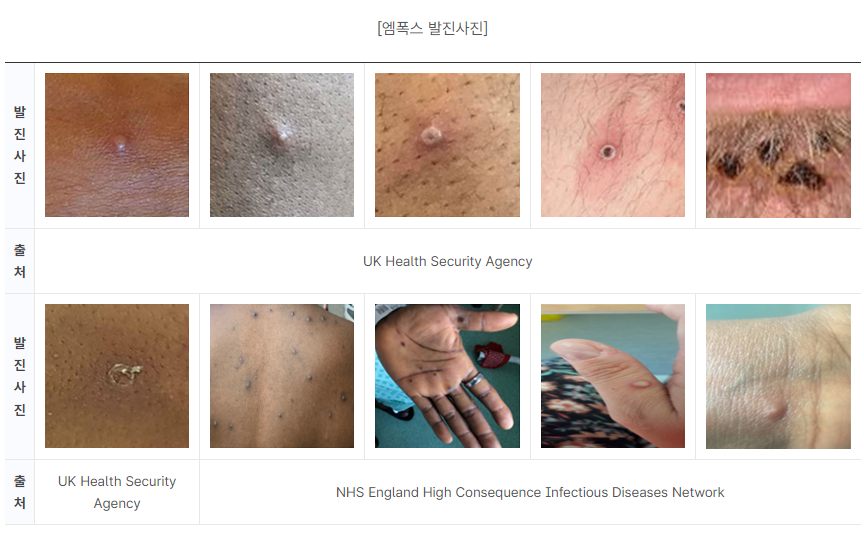 엠폭스 발진 사진