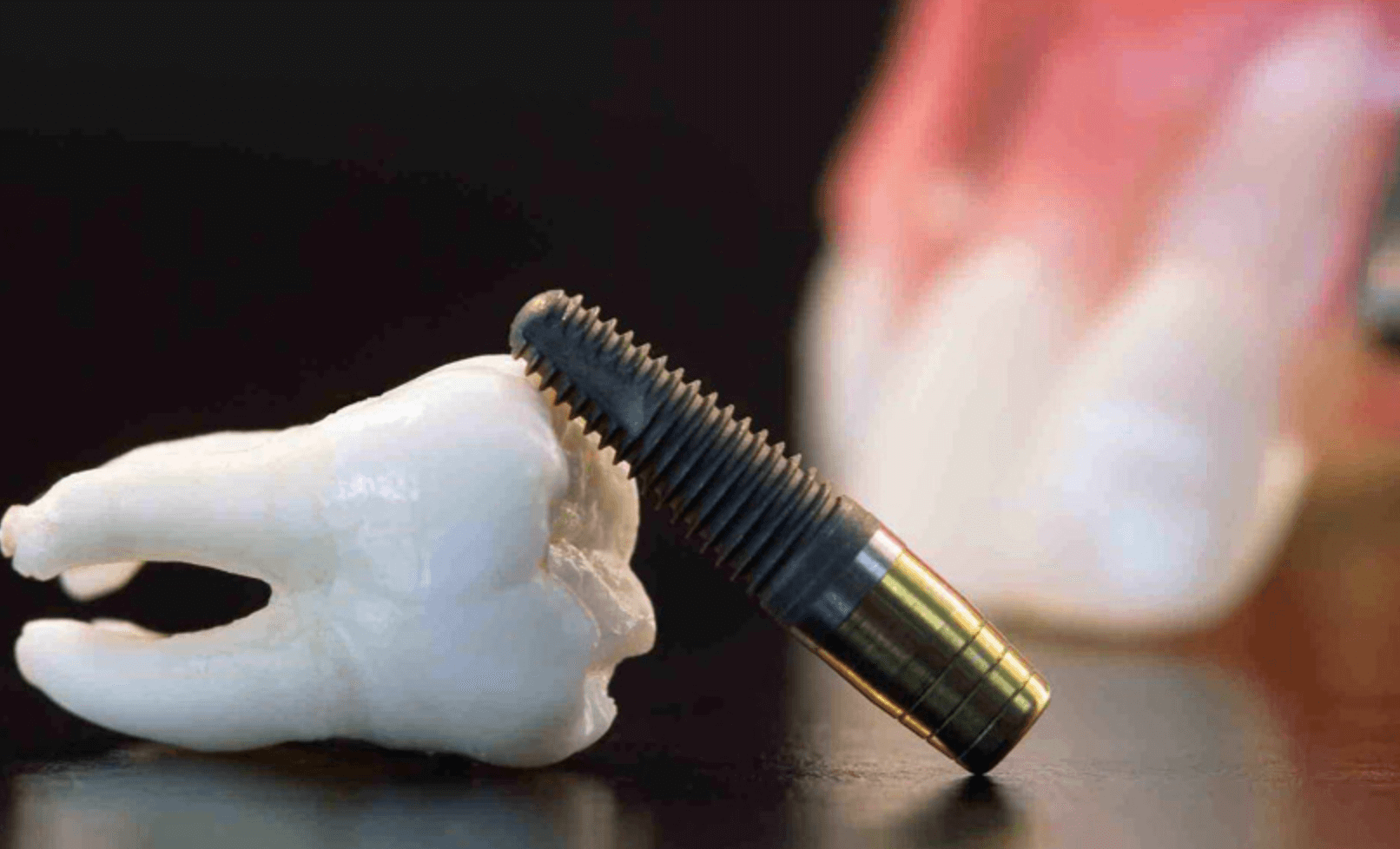 뼈이식 임플란트