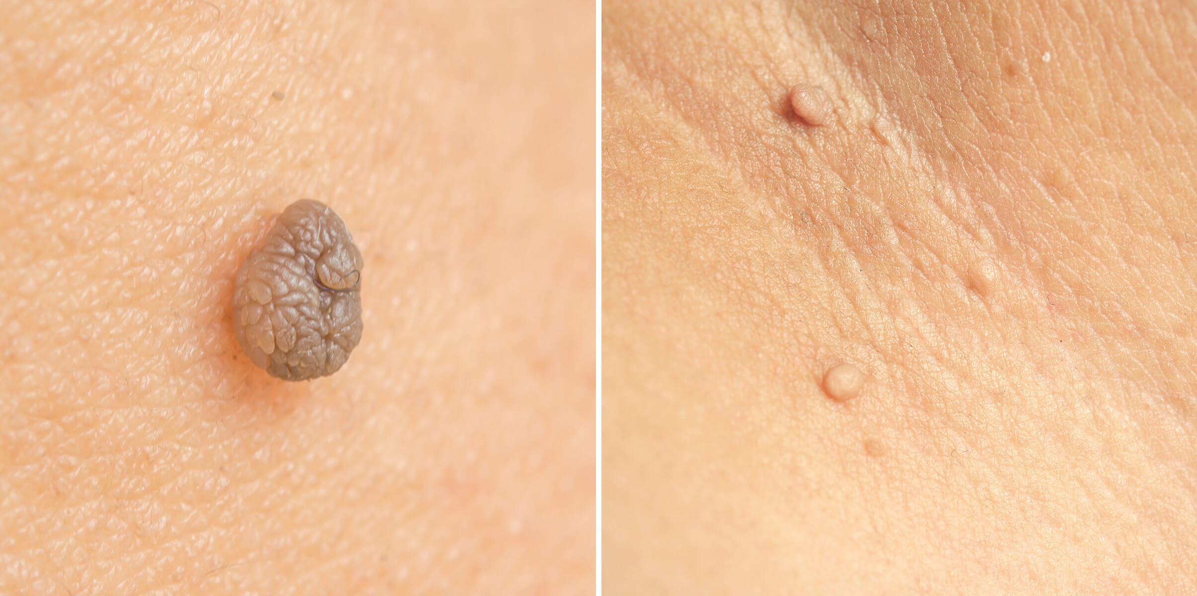 쥐젖이 생기는 이유