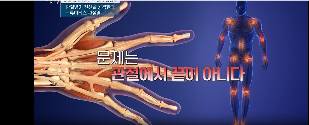 명의-류마티스 관절염이 전신을 공격한다