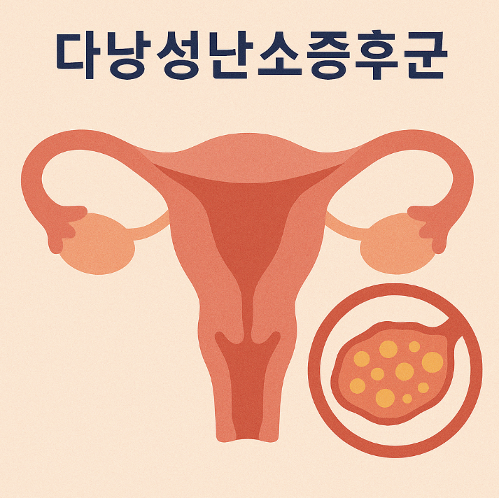 다낭성난소증후군, 증상과 관리 방법