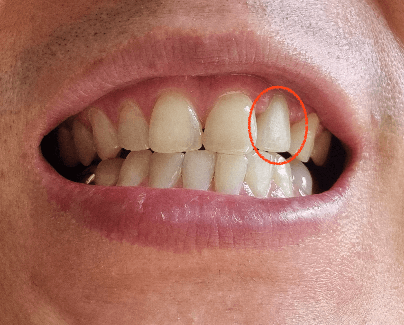 지르코니아 후기