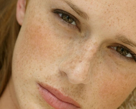 얼굴 검버섯 없애는 방법