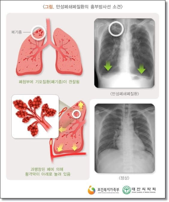 만성폐쇄성폐질환