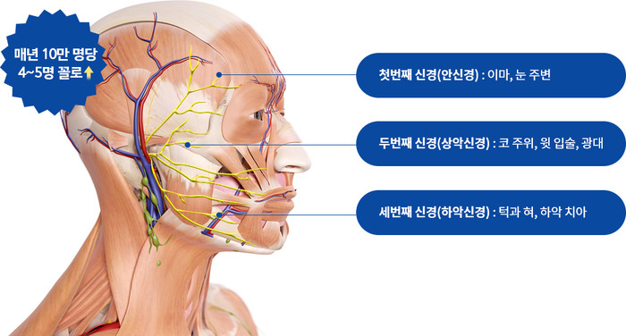 EBS 명의 삼차신경통 원인 증상 치료