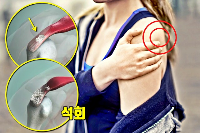 어깨통증 원인, 석회화건염 원인 치료 최에충격파, 좋은 운동, 건강 팁줌 매일꿀정보